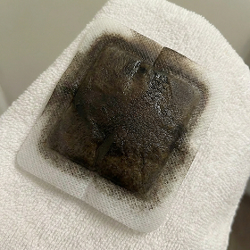 Plaster po 3 tygodniach